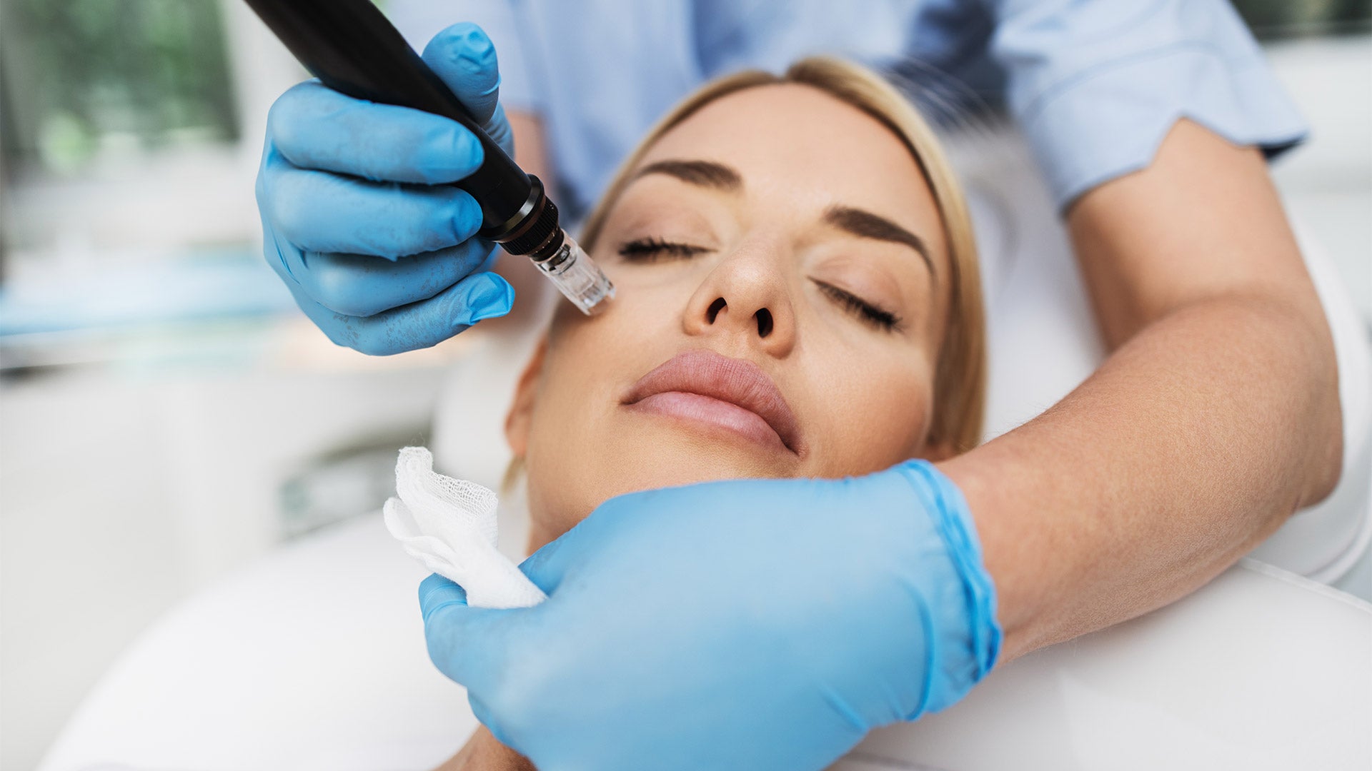 Microneedling procedure