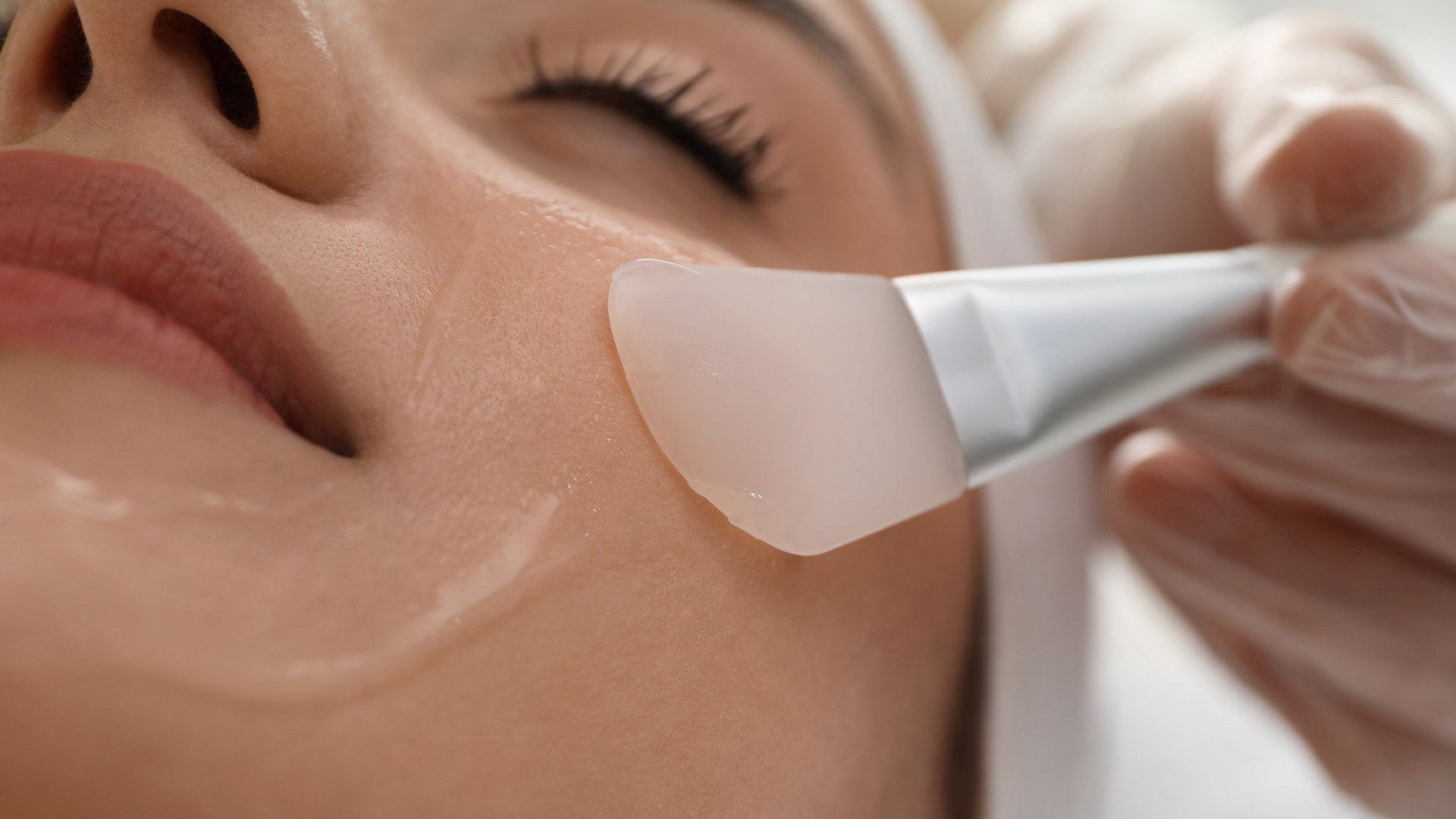Chemical peel procedure