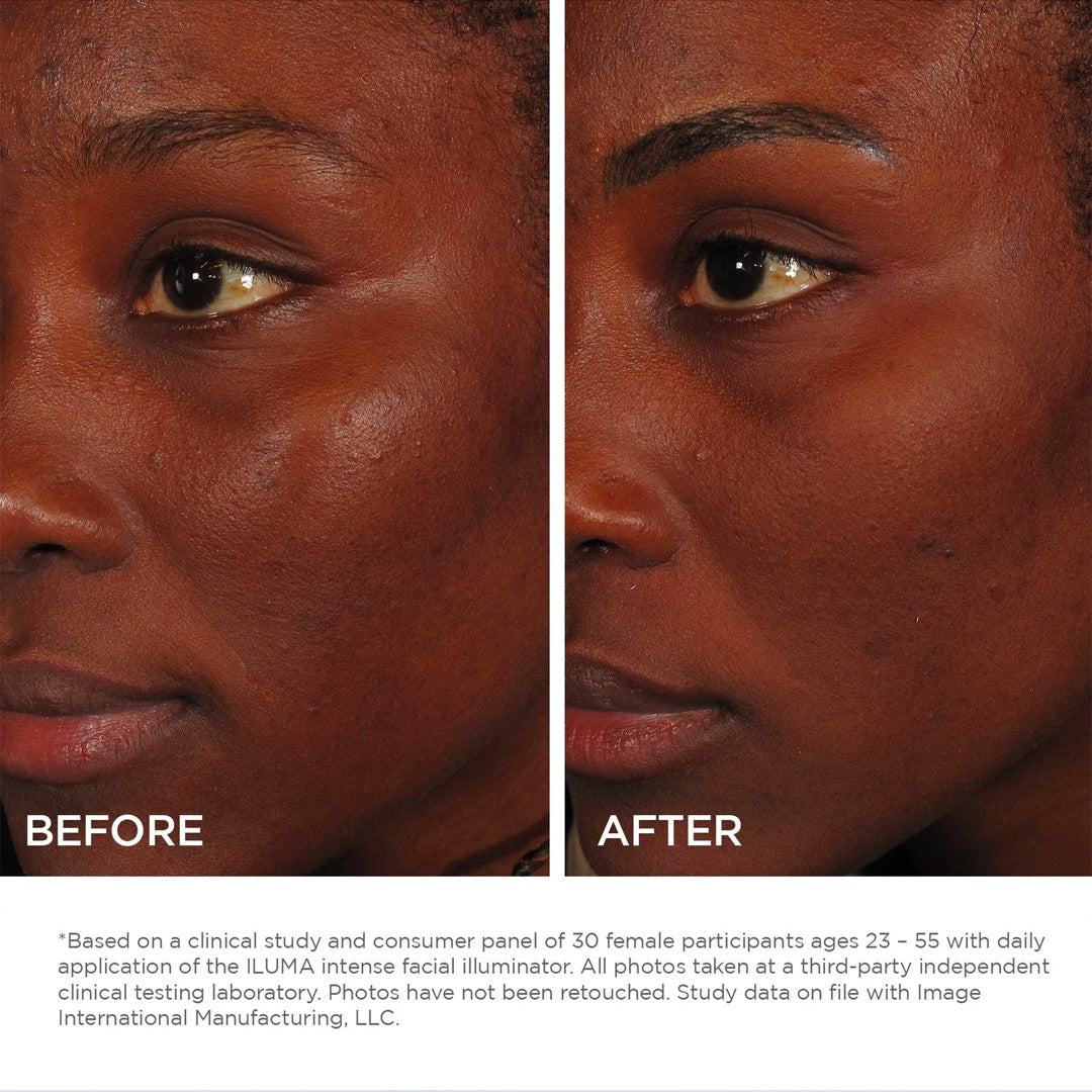 ILUMA Intense Facial Illuminator